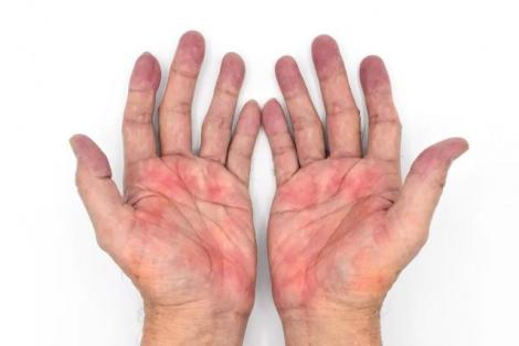Thấy 3 dấu hiệu này ở bàn tay, có thể bạn đang mắc gan nhiễm mỡ nặng